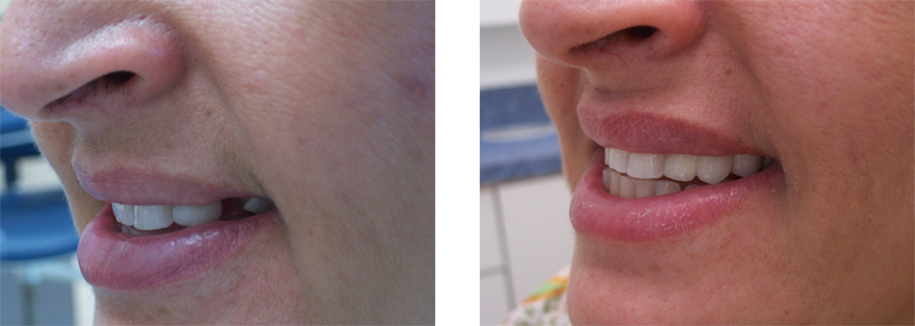 Fixed Porcelain Bridge - Before and After Images.