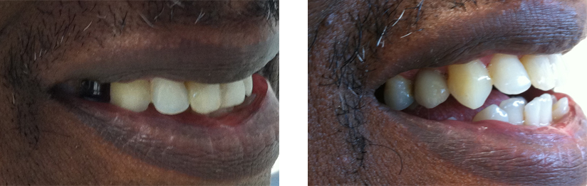 Implant Abutment and Retained Crown - Before and After Images.
